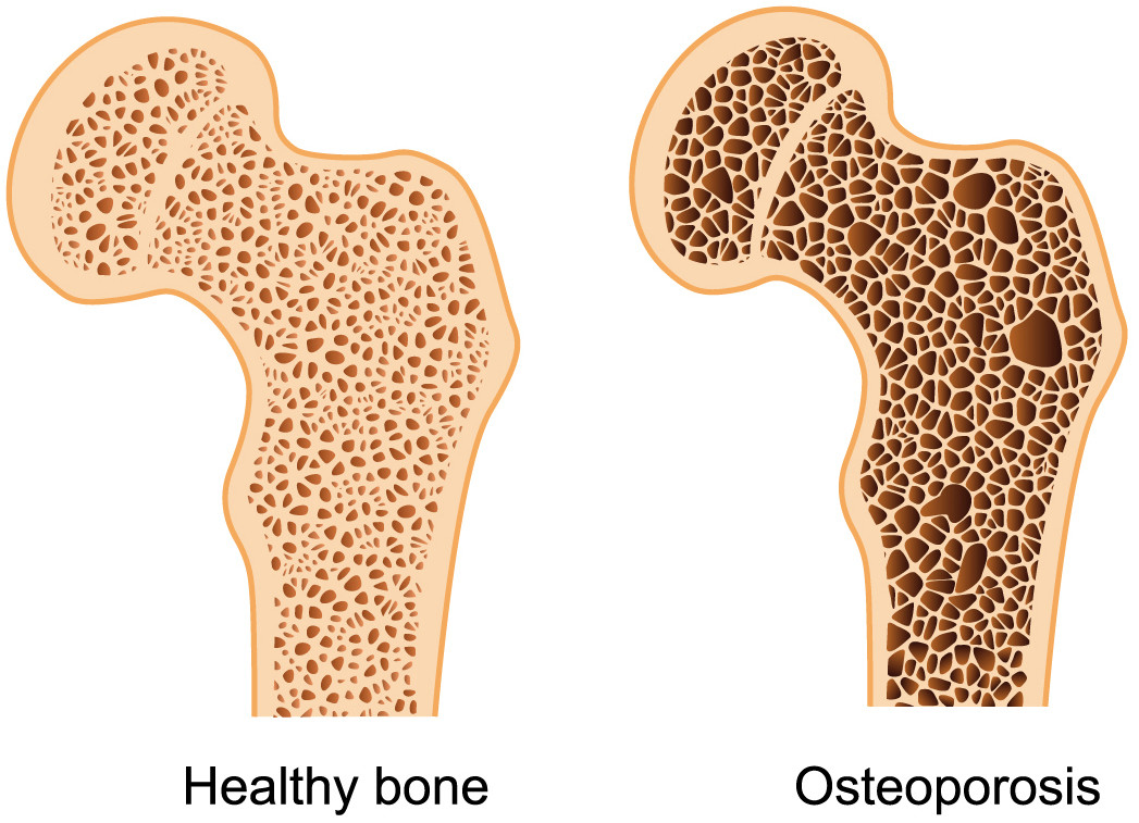 Bone Density in Healthy Tissue and Osteoporosis